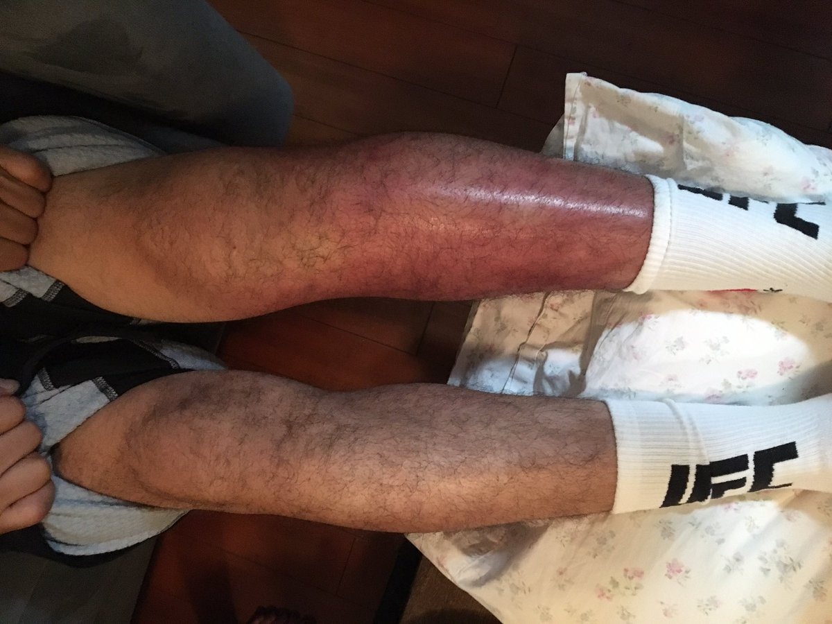 Vo si UFC chiu dau thi dau het tran du chan bi sung bien dang hinh anh