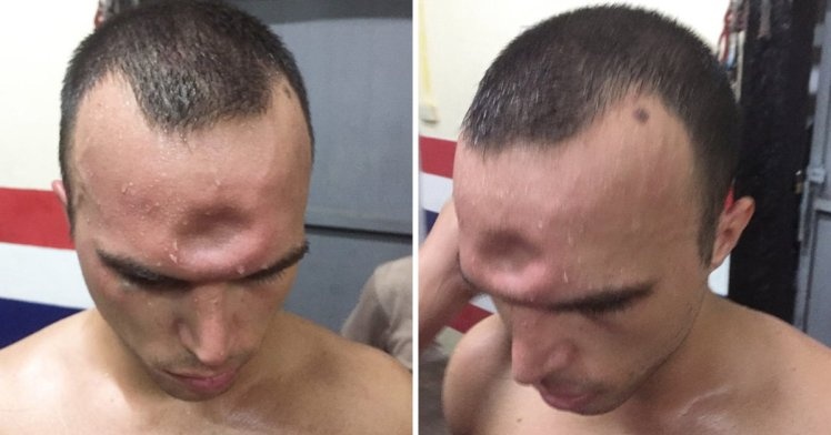 Công bố đoạn clip ghi lại cảnh võ sĩ bị lõm sọ sau đòn giật chỏ  ảnh 1 Cong bo doan clip ghi lai canh vo si bi lom so sau don giat cho anh 1