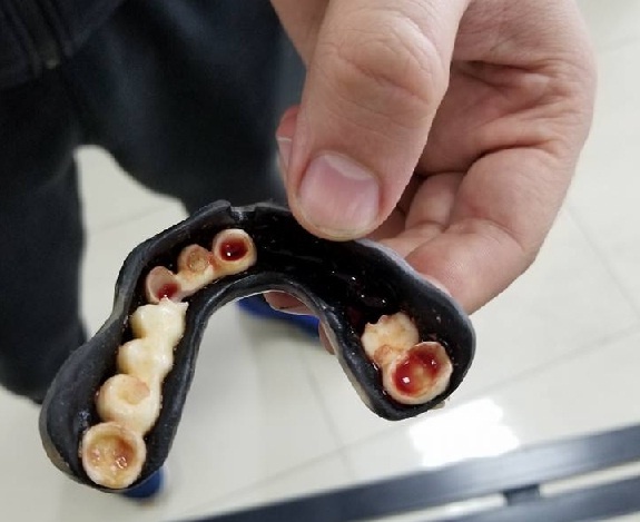 Dùng bảo hộ răng rẻ tiền,  võ sĩ Trung Quốc mất cả hàm răng ảnh 1 Dung bao ho rang re tien,  vo si Trung Quoc mat ca ham rang anh 1