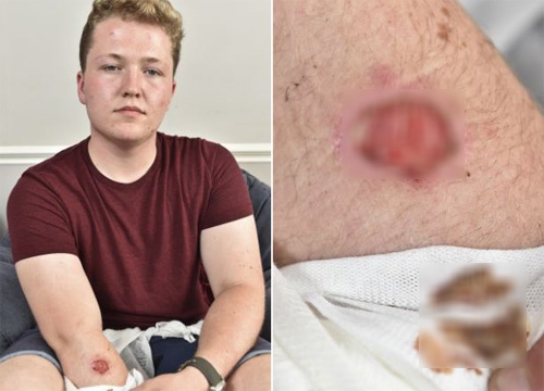 Mot nguoi dung bi bong do iPhone 5 nong bat thuong hinh anh