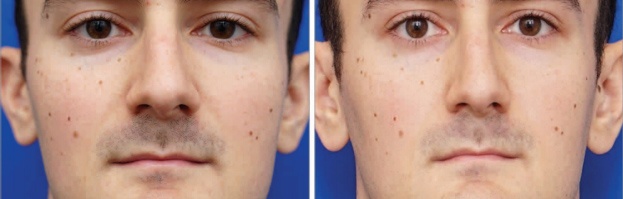 Selfie khien mui ban to hon anh 2