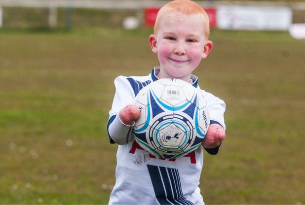 Nghi luc phi thuong cua cau be khiem khuyet tay chan hinh anh