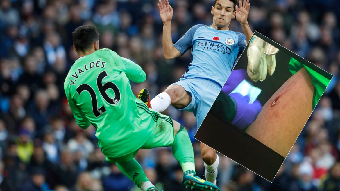 Rợn người chấn thương kinh hoàng của Victor Valdes ảnh 1 Ron nguoi chan thuong kinh hoang cua Victor Valdes anh 1