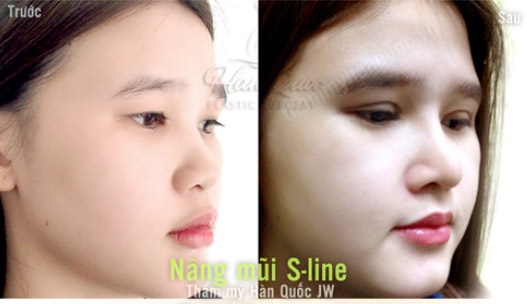 Nang mui S Line bang sun tu than hinh anh