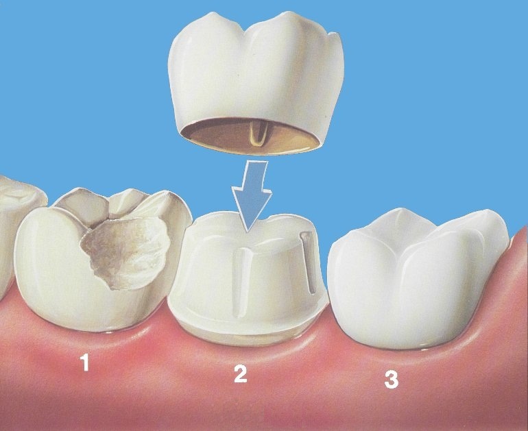 Mô tả răng sứ.