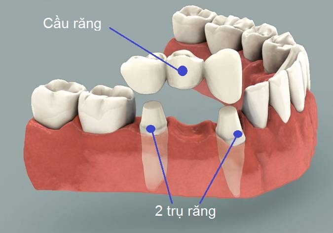 Sơ đồ mô tả cầu răng.