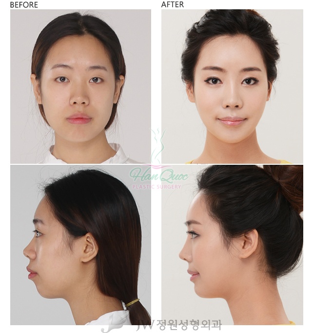 Hình ảnh thẩm mỹ toàn diện khuôn mặt bao gồm: thẩm mắt hai mí, làm to mắt, Nâng mũi s line, phẫu thuật hàm hô, độn cằm v line, làm cao trán và đầy đặn, trị nám trẻ hóa da (hình ảnh độc quyền của thẩm mỹ JW).