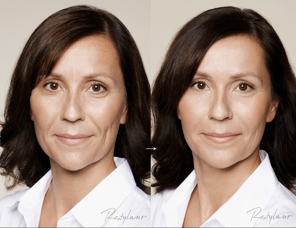 Tre lai nho botox, restylane hinh anh