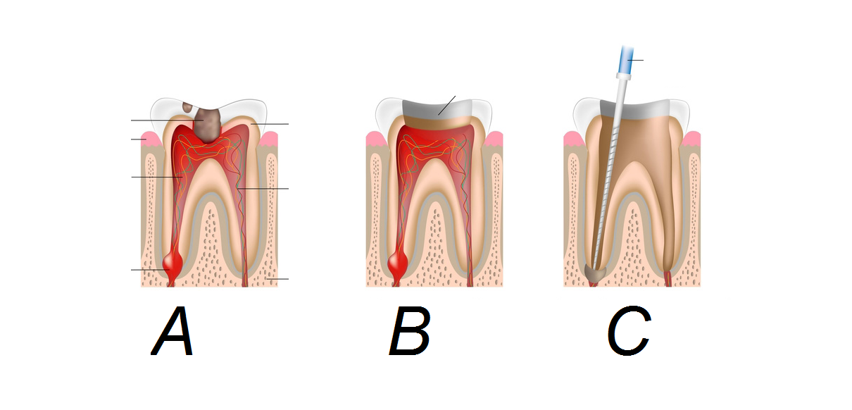 Răng bị tổn thương (A); được gây tê và mở lấy tủy (B) & (C).