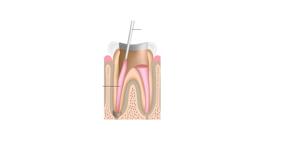 Ống tủy được bít bằng côn gutta percha.