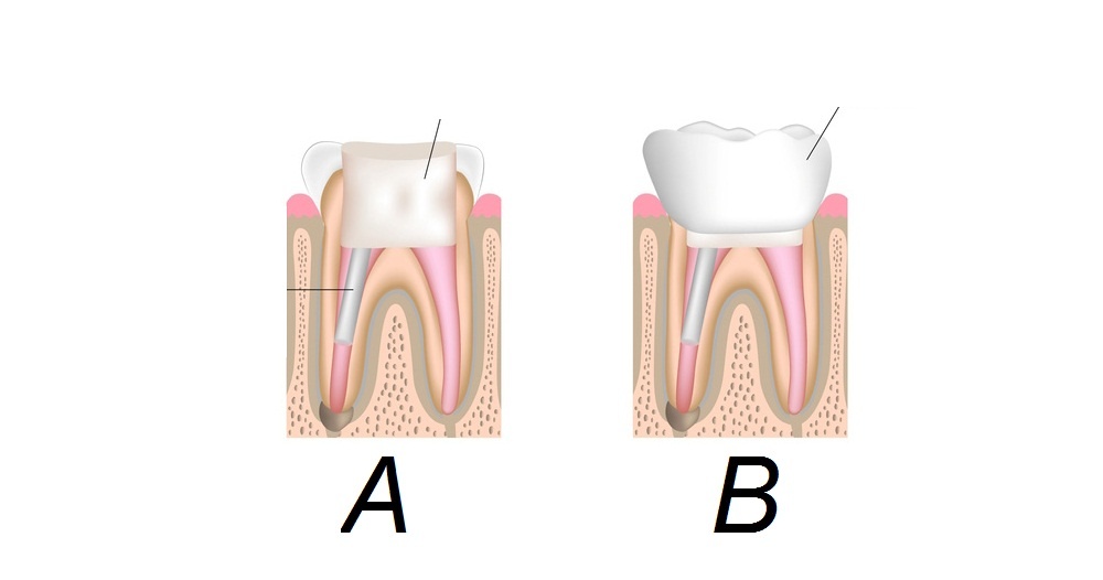 Cuối cùng răng được trám (A) hoặc bọc răng sứ (B).