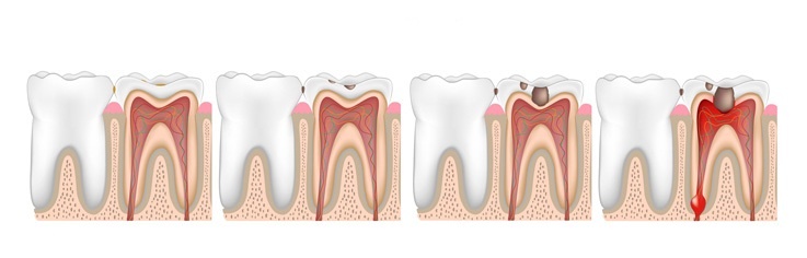 Tiến triển của sâu răng.
