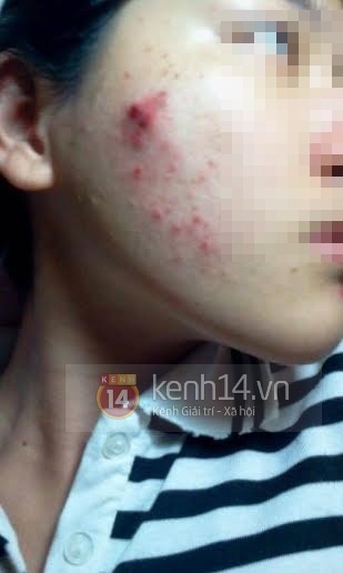 T. cho biết gương mặt bị lở loét sau quá trình trị liệu tại K.M Spa.
