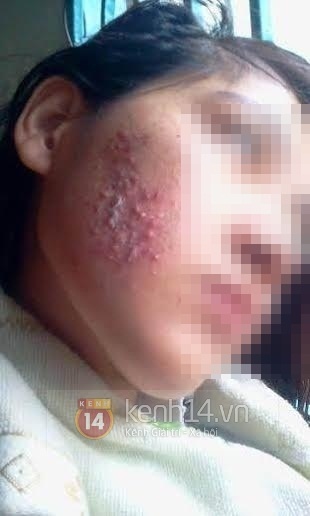 Có những lúc T. rơi vào tuyệt vọng vì gương mặt biến dạng xấu xí.