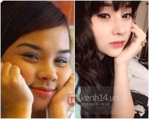 Co gai Ha Noi lot xac sau phau thuat tham my hinh anh