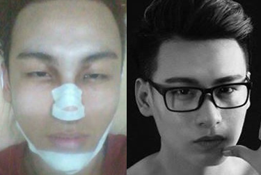 Su lot xac cua chang trai 17 tuoi nho phau thuat tham my hinh anh