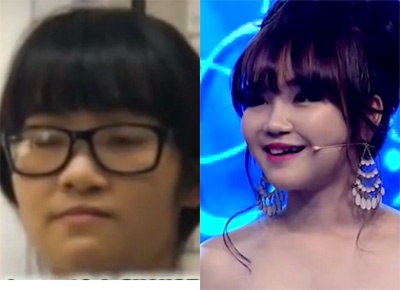 Nu sinh DH Ngoai ngu truoc va sau khi phau thuat tham my hinh anh