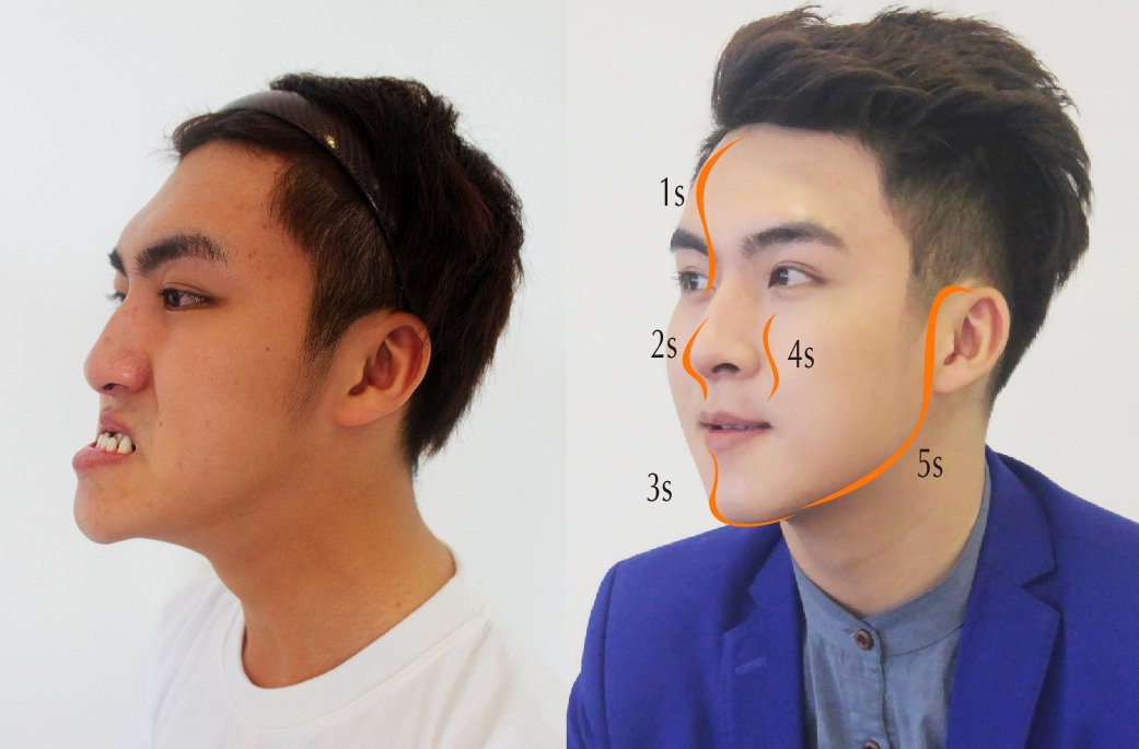 Chang trai Ha thanh ham nho doi doi nho phau thuat tham my hinh anh