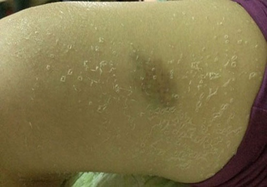 Thiếu nữ Hà Nội bị lột da như rắn vì tắm trắng