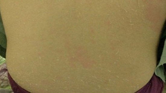 Thiếu nữ Hà Nội bị lột da như rắn vì tắm trắng