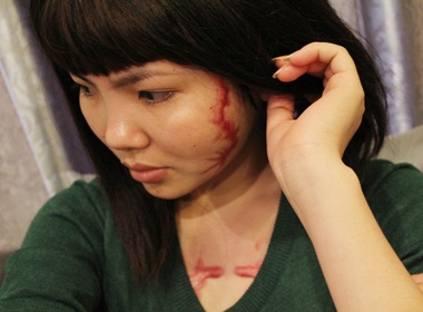 Hang loat bat thuong vu xam hinh ret len mat, nguc nhan vien hinh anh