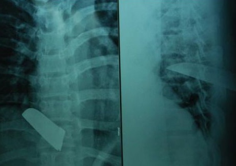 Cuu song mot benh nhan bi thung tim hinh anh