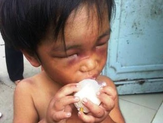 Be 3 tuoi bi cham tan thuoc, danh bam mat bat di an xin hinh anh