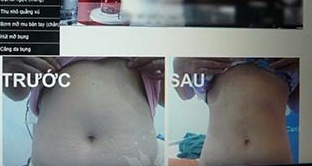 Nguoi Sai Gon van vo tu hut mo bung sau vu chi Huyen hinh anh