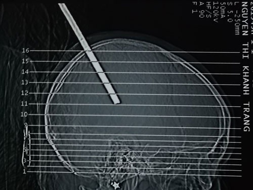 Mo lay cay sat xuyen hop so gan 11cm hinh anh