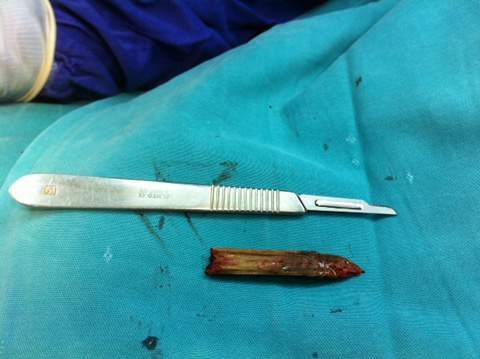 Rut thanh tre dai 5cm sau 9 thang nam xuyen nao hinh anh