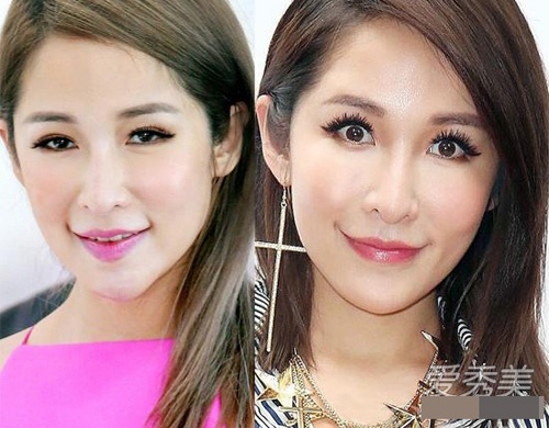 Theo thời gian, di chứng thẩm mỹ càng lộ rõ trên khuôn mặt của Tiêu Á Hiên