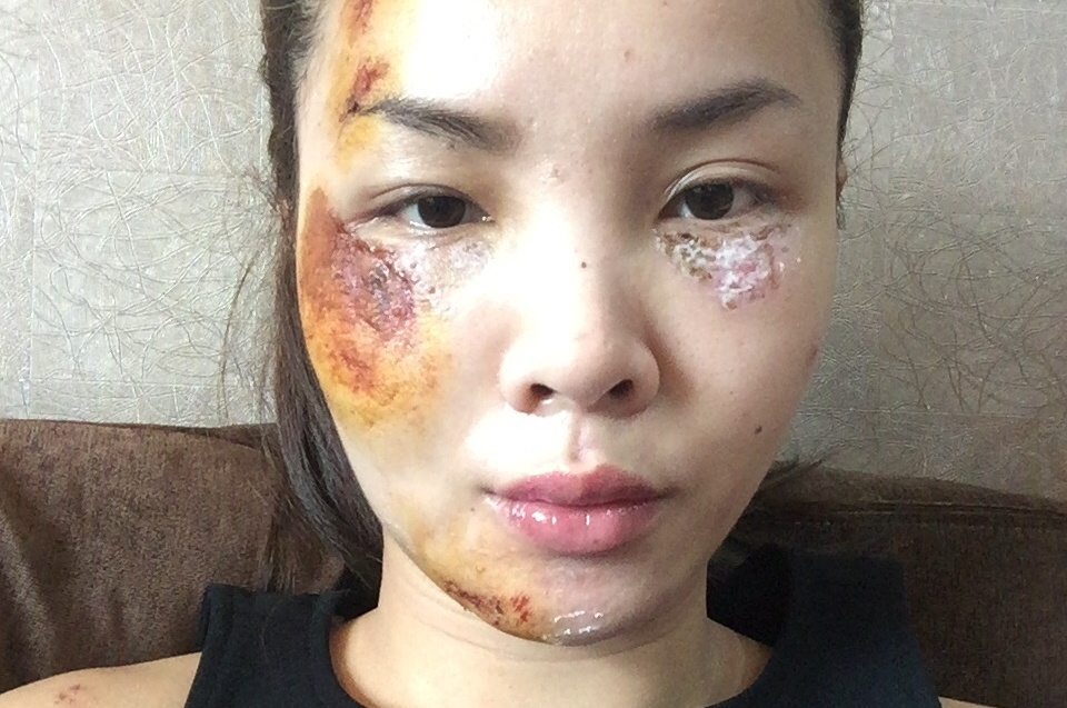 Yen Trang dang anh guong mat tray xuoc sau tai nan hinh anh