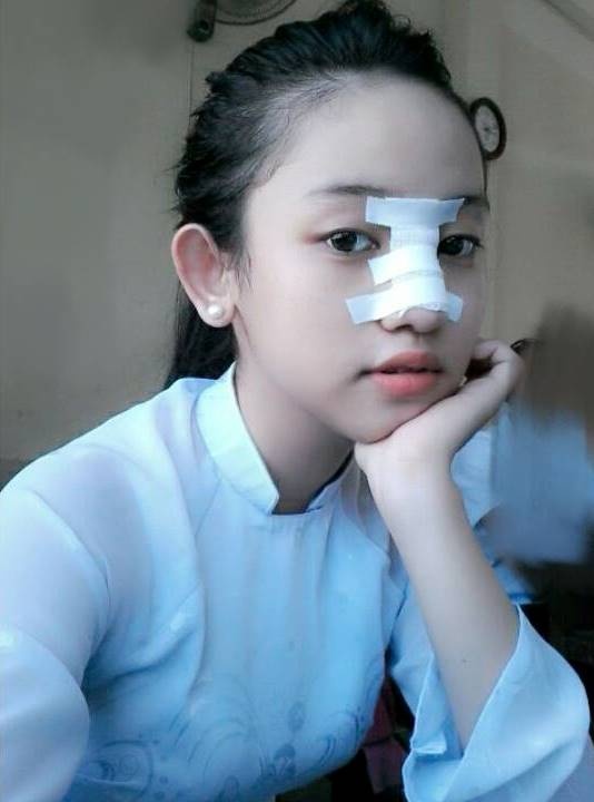 Thúy Vi công khai hình ảnh nâng mũi trên trang cá nhân.