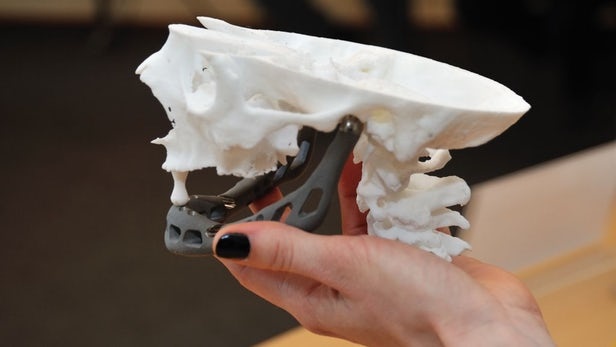 May in 3D giup thay the xuong hong cho benh nhan hinh anh