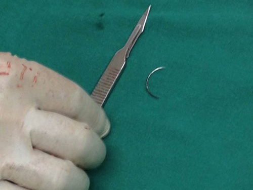 Phau thuat lay kim 'de quen' trong bung benh nhan 15 nam hinh anh