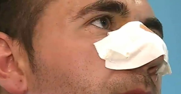 Cau thu dien cuong huc dau lam vo mui trong tai hinh anh