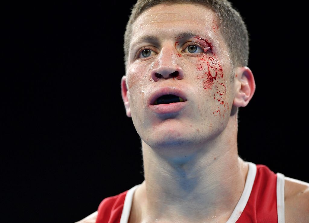 VĐV Algeria bị đánh rách mí mắt ảnh 3 VDV Algeria bi danh rach mi mat anh 3