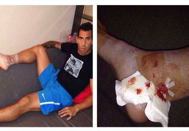 Lo anh chan thuong hai hung cua Tevez hinh anh