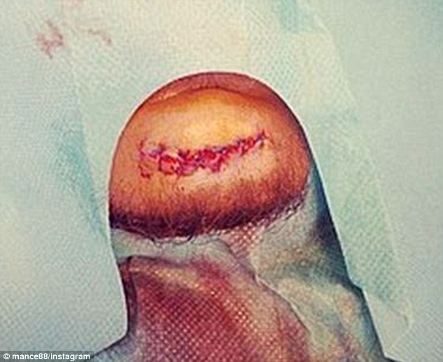 Chiếc cằm của Mancienne sau khi được khâu lại. Ảnh: Daily Mail.