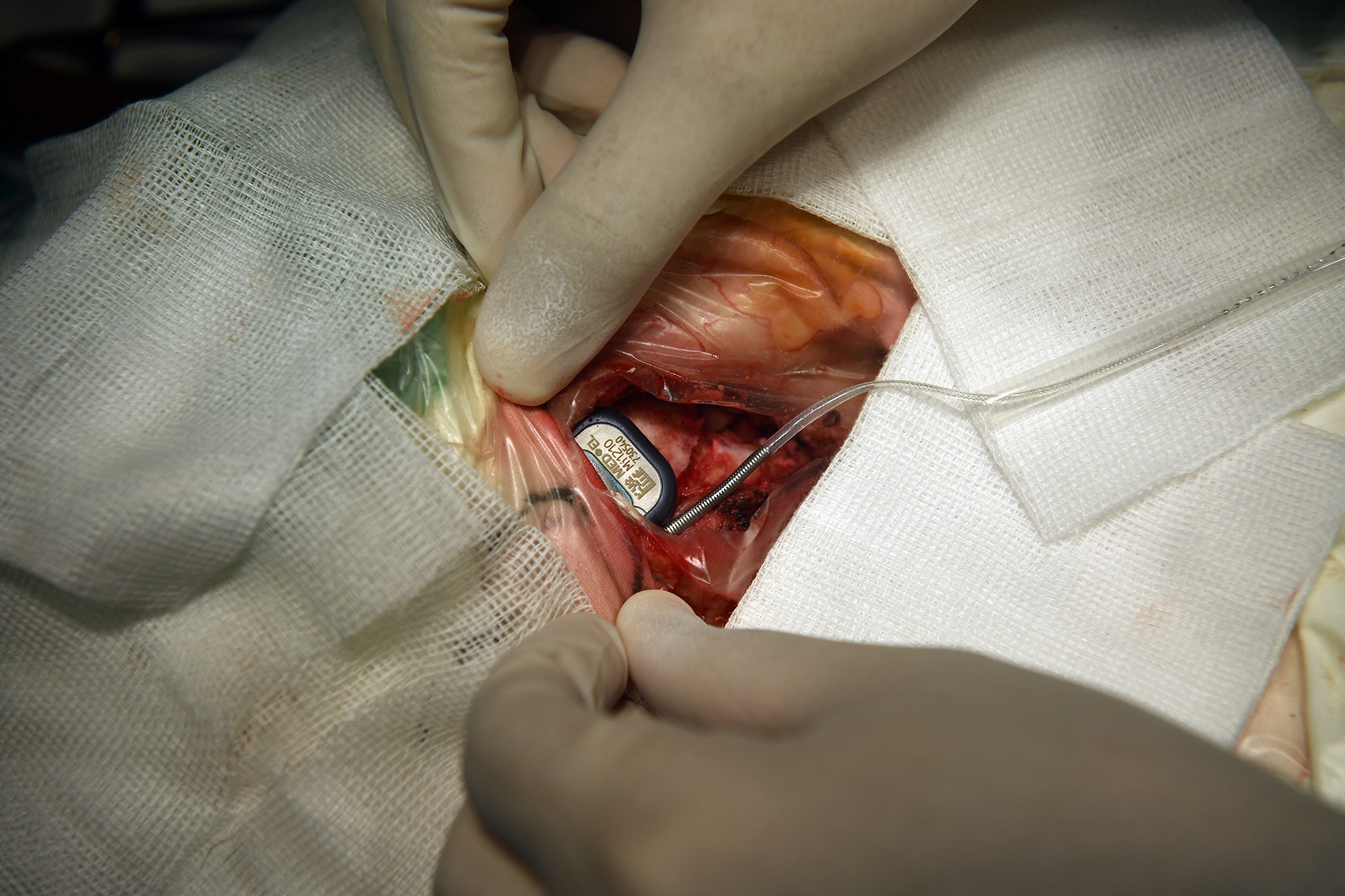 Ca phau thuat diec bam sinh anh 14