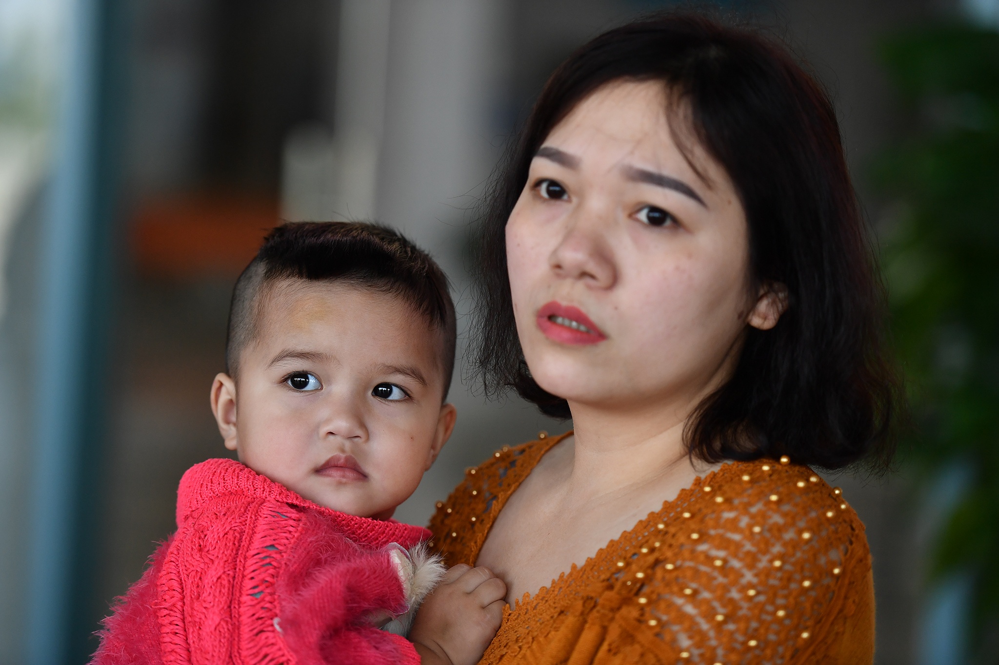 Ca phau thuat diec bam sinh anh 1