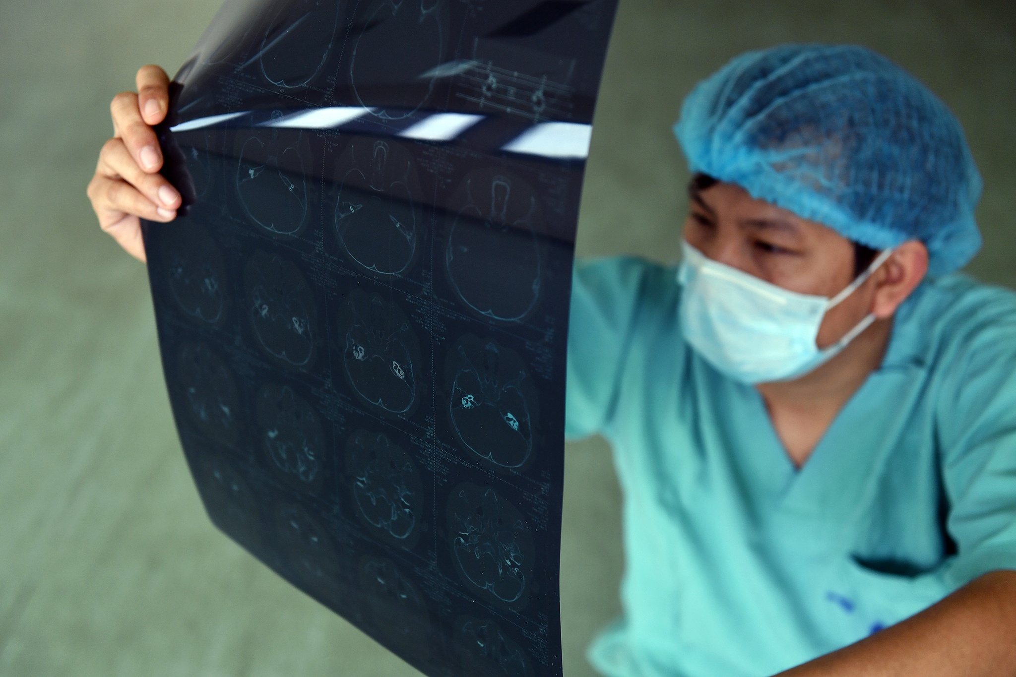 Ca phau thuat diec bam sinh anh 2