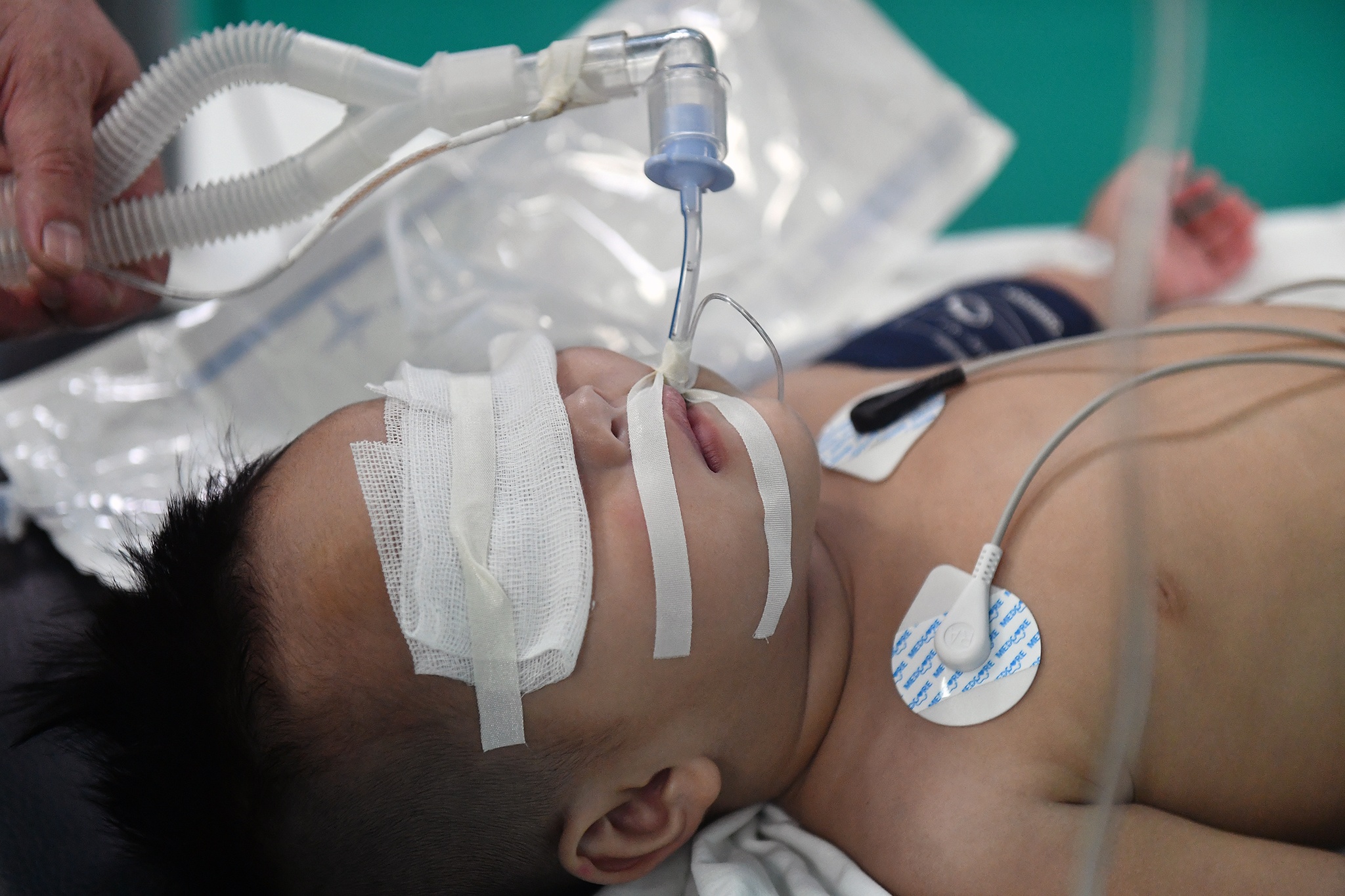 Ca phau thuat diec bam sinh anh 6