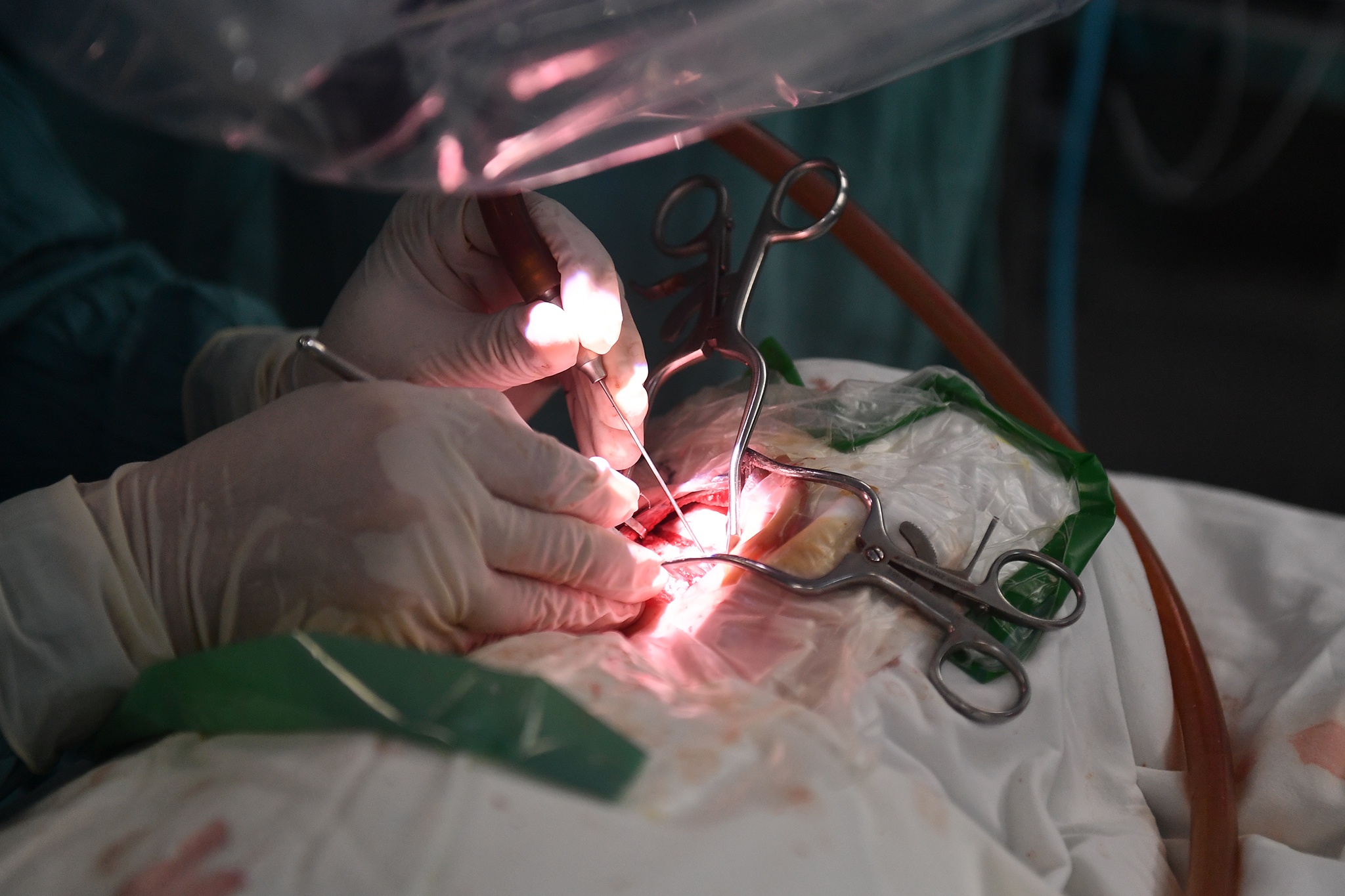 Ca phau thuat diec bam sinh anh 8