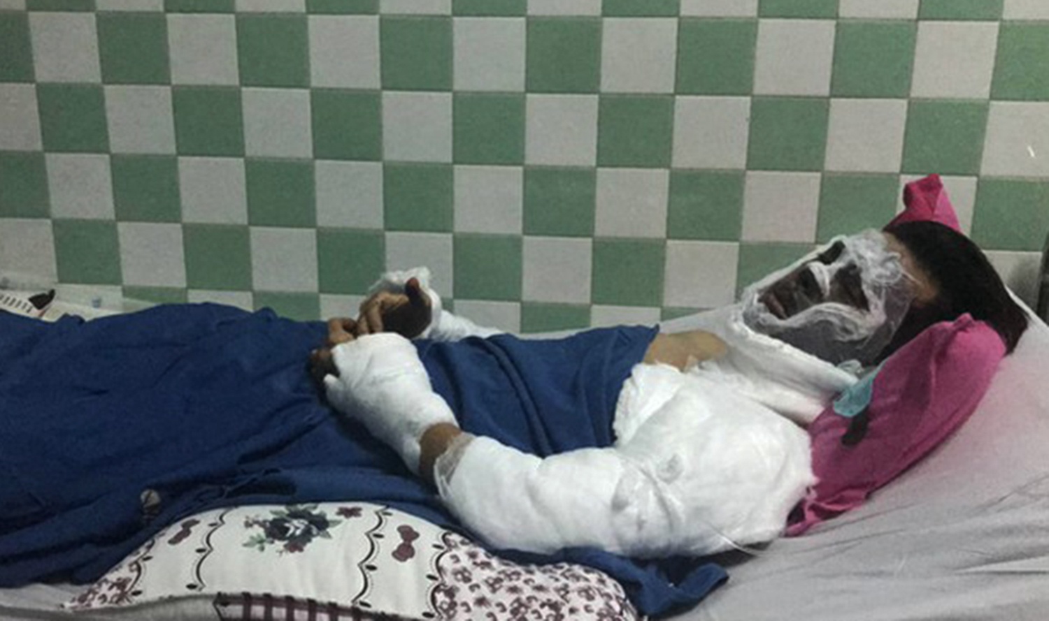 Viet kieu bi tat axit ngay Tet: Doi mat bi ton thuong nang hinh anh