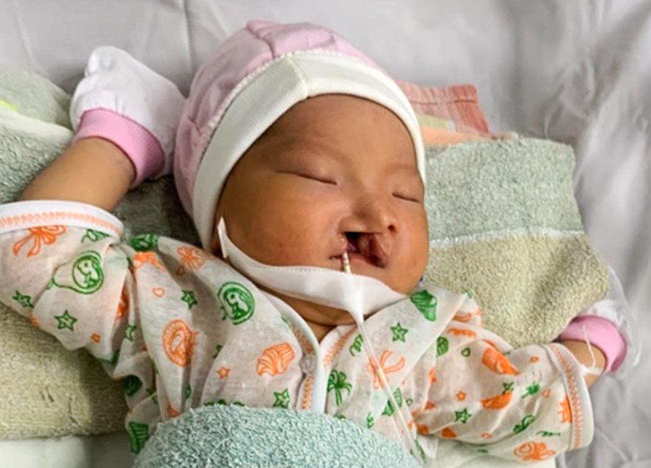 Trẻ sứt môi hở hàm ếch ảnh 1 Tre sut moi ho ham ech anh 1