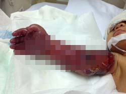 Be gai sinh thieu thang co canh tay bi hoai tu hoan toan hinh anh