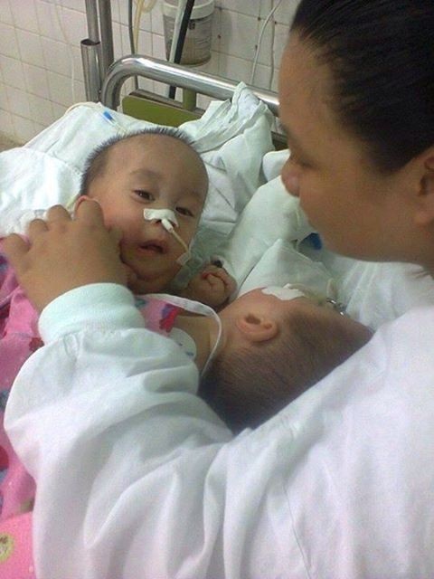 1 trong 2 be song sinh dinh lien duoc mang ve que mai tang hinh anh