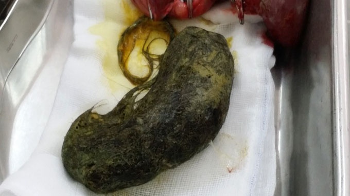 An toc suot 2 nam, mot be gai bi thung ruot hinh anh