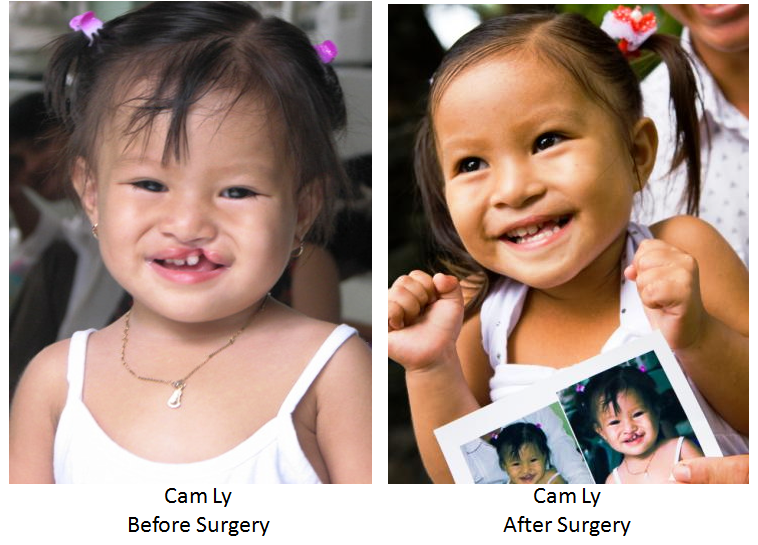 Ban dau gia gay quy phau thuat ho ham ech cho tre em hinh anh